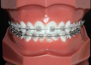 矯正装置について