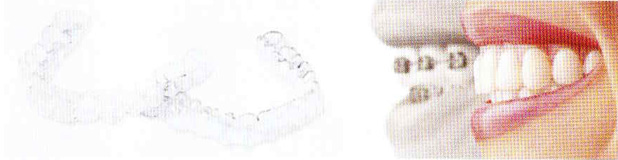 見えない矯正クリアアライナー(透明マウスピース)