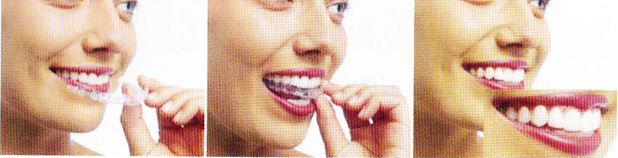 見えない矯正クリアアライナー(透明マウスピース)