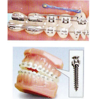 ミニスクリュー(MIA)