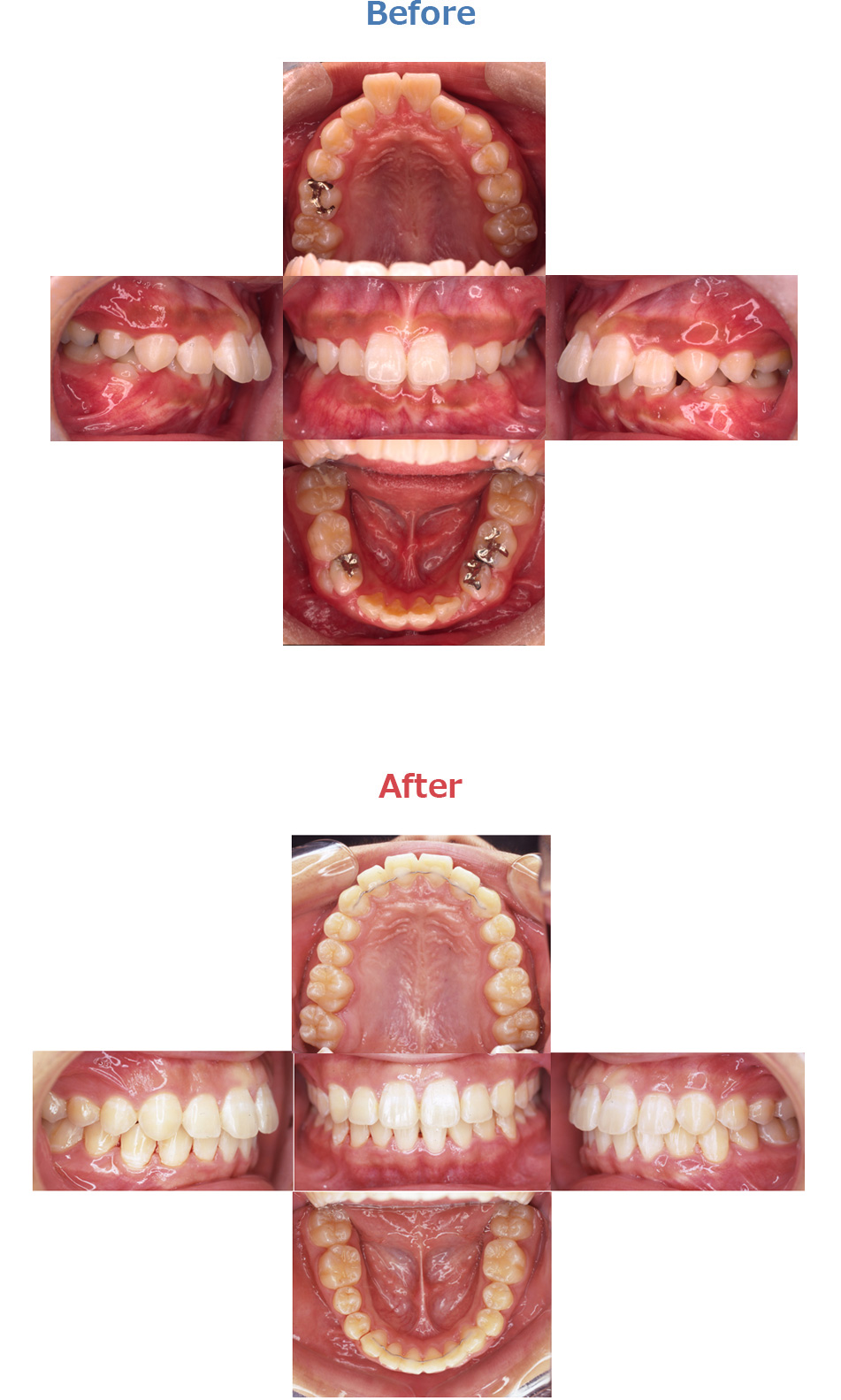 上顎前突の症例