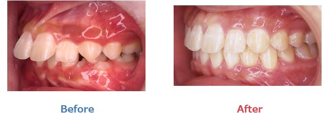 上顎前突の症例