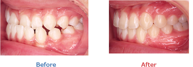 下顎前突、反対咬合の症例