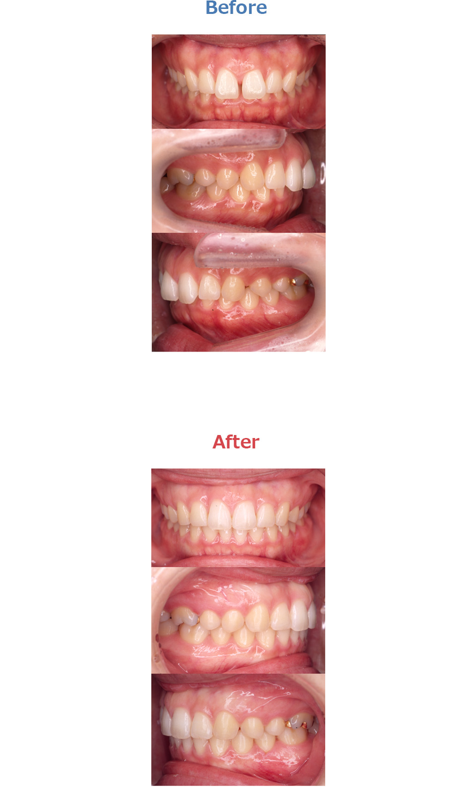 過蓋咬合の症例