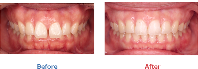 過蓋咬合の症例
